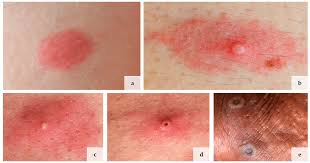monkeypox symptoms